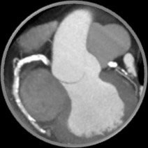 ffrct anatomical insights