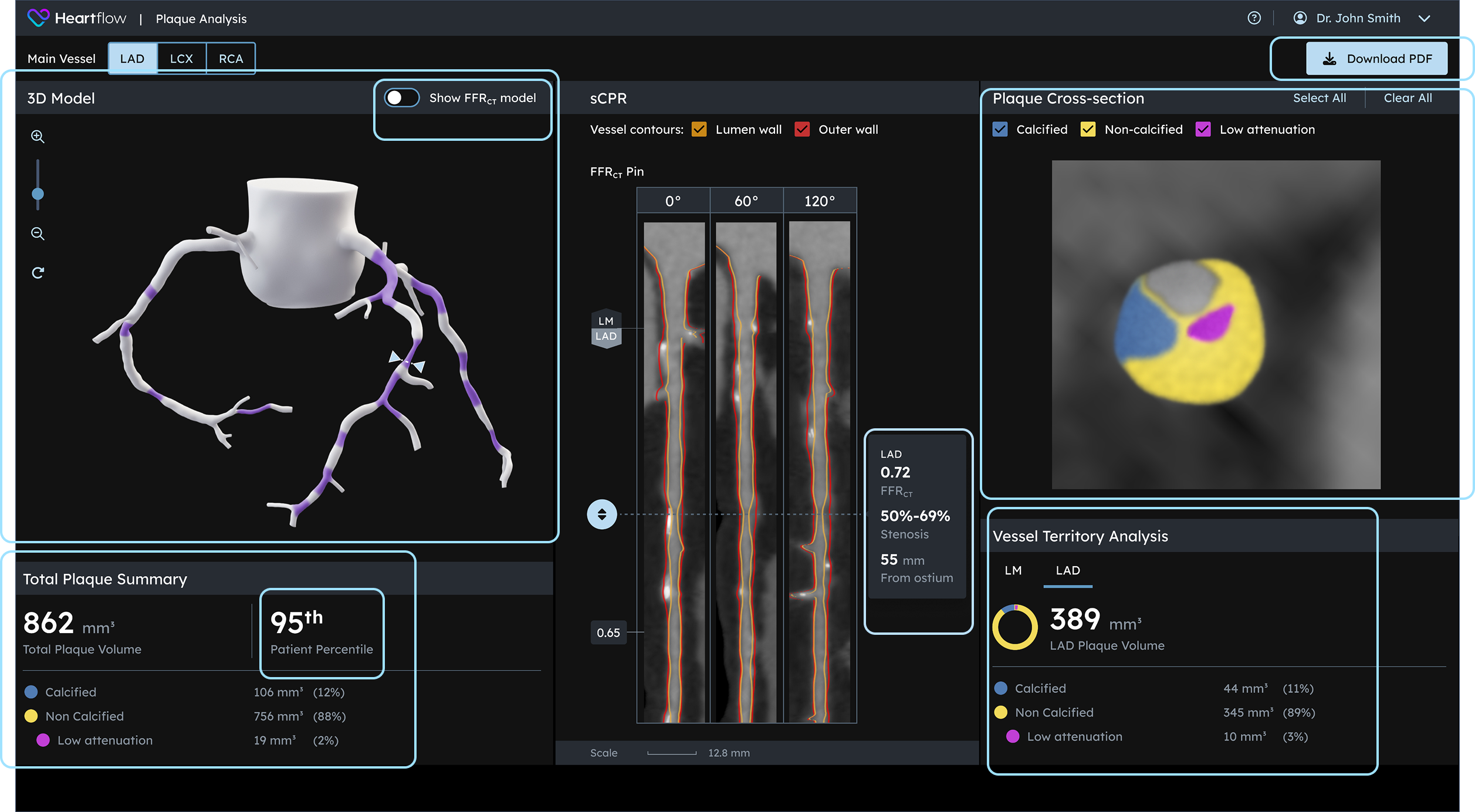 screenshot of plaque analysis