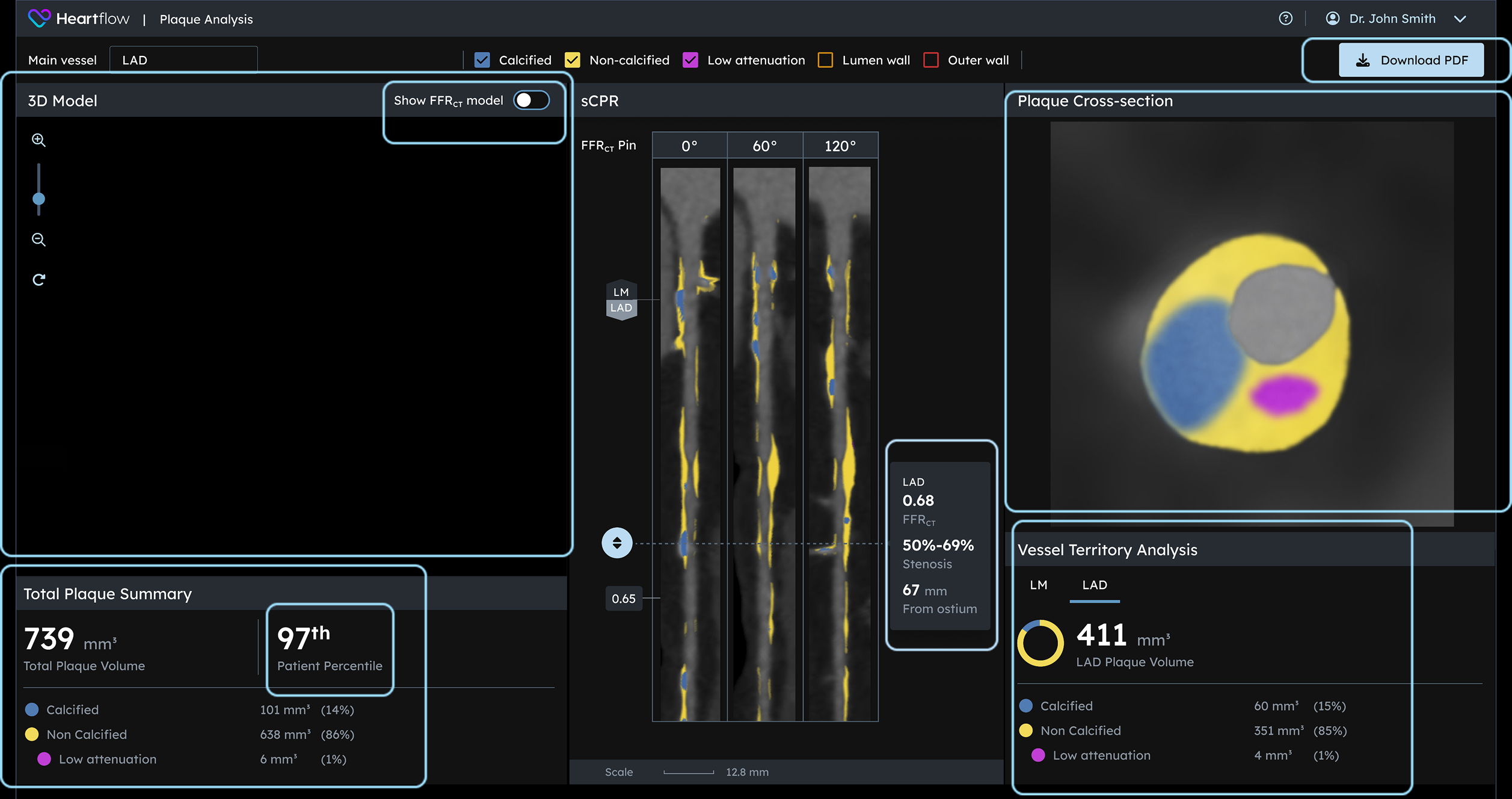 screenshot of plaque analysis