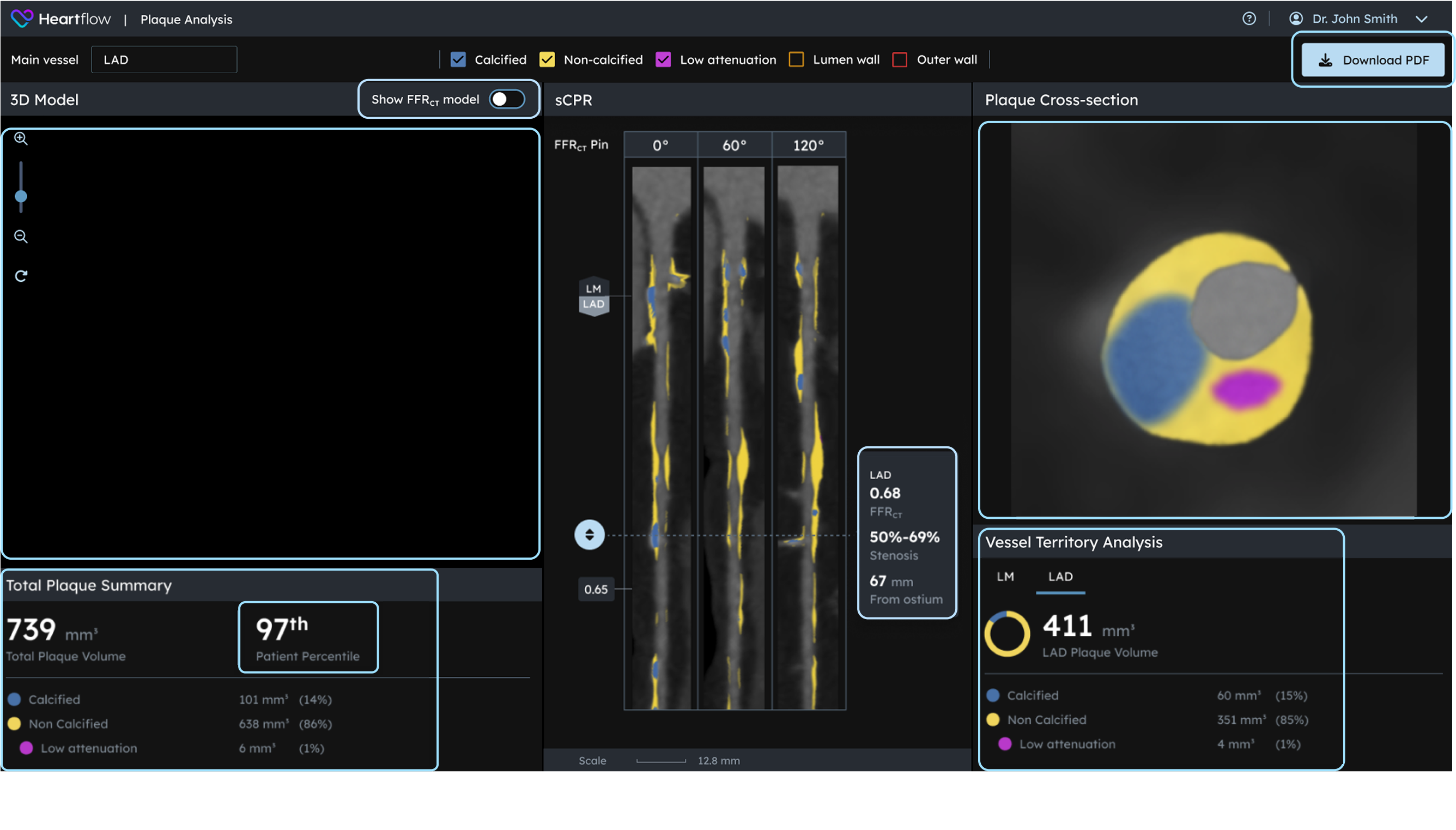 screenshot of plaque analysis