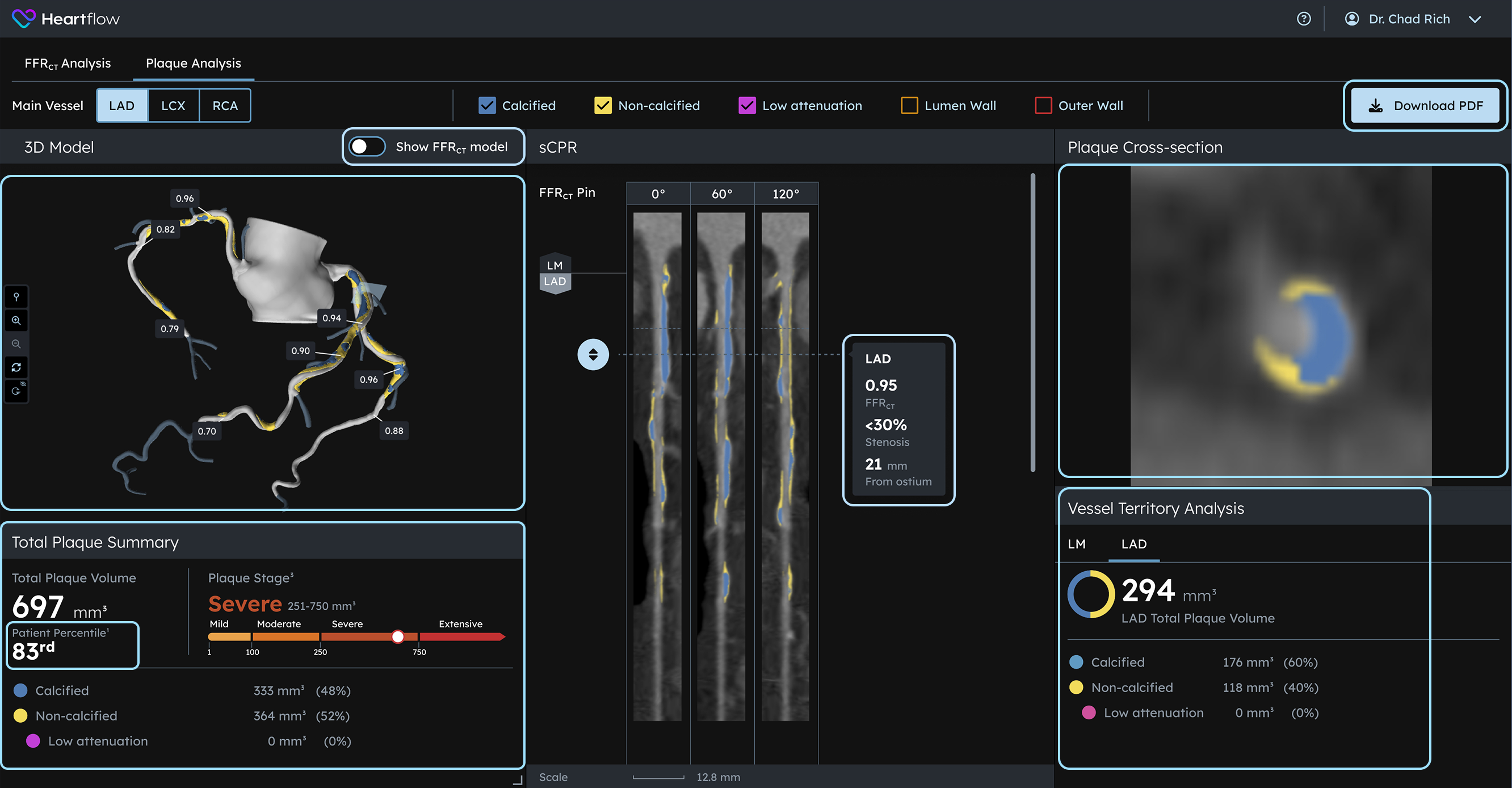 screenshot of plaque analysis