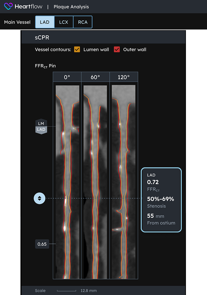 How Plaque Analysis Works diagram