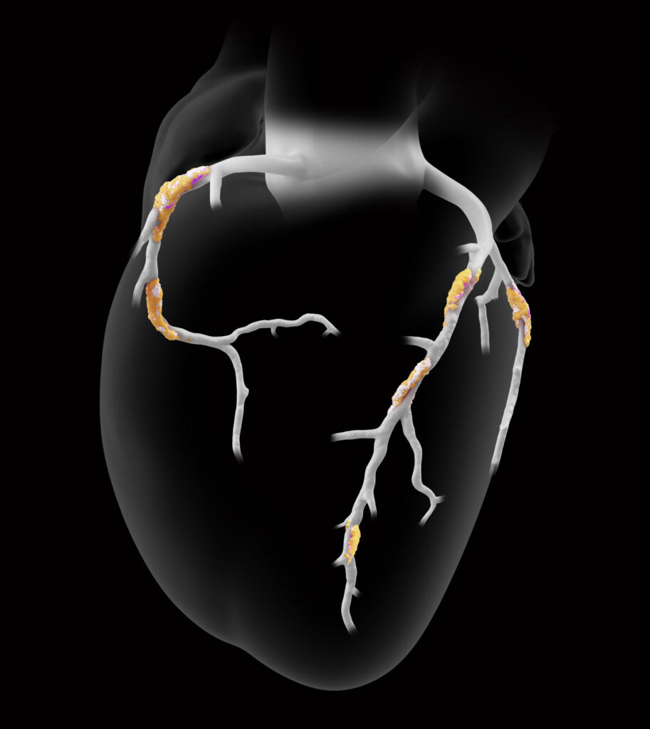 plaque heart rendering