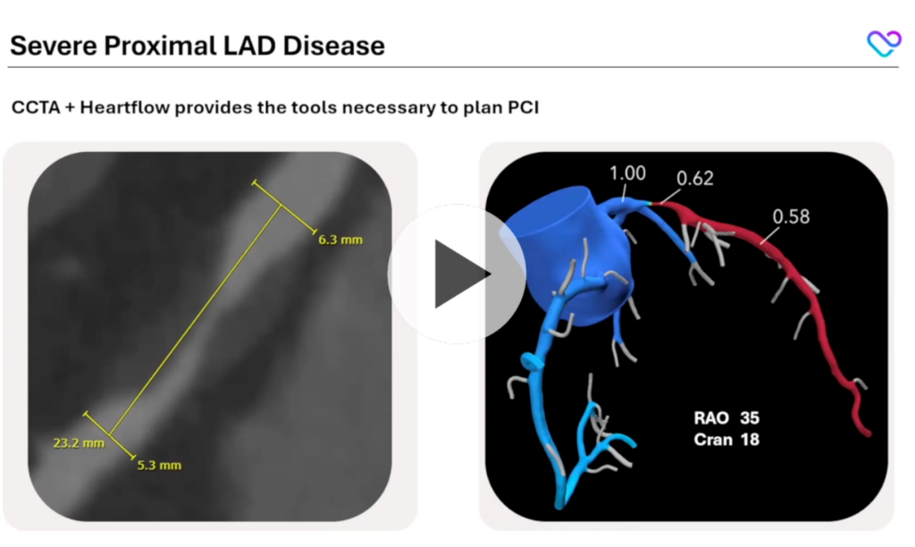 severe proximal lad disease