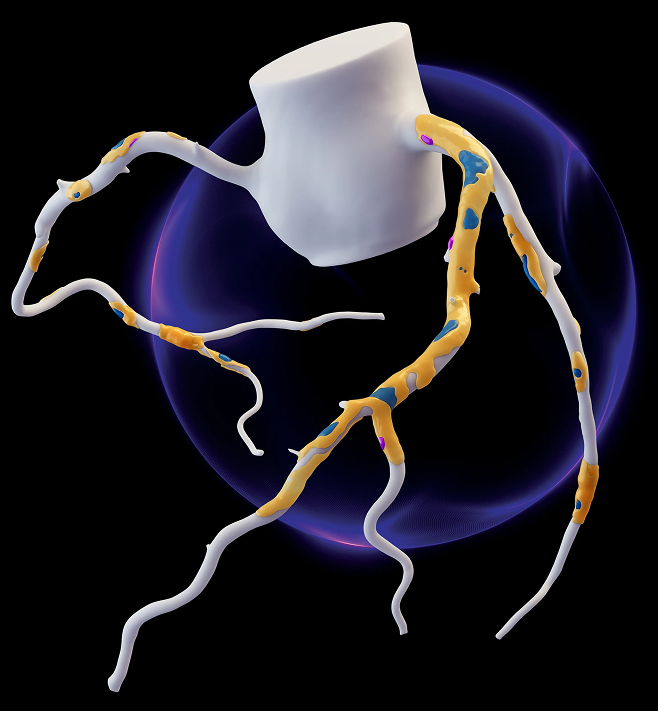 3D Artery with Plaque